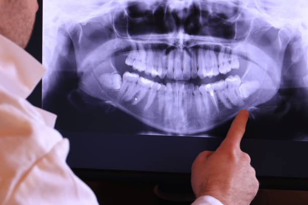 Best Emergency Wisdom Teeth Removal in University Of Lifornia Davis, CA